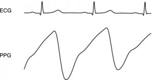 ECG and PPG QRS signals for heart rate calculation